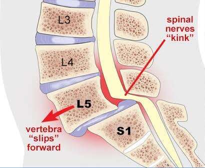 Spondylosis and Spondylolisthesis