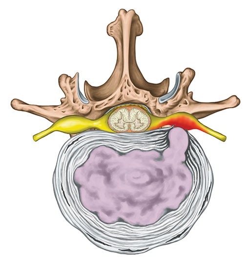 Disc Herniation