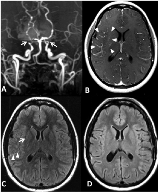 Congenital Malformation