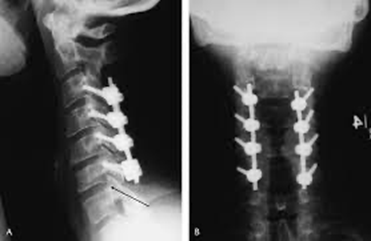 Spinal Fusion Surgery